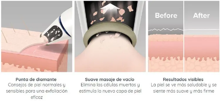 Máy tẩy da chết MDA-100 HoMedics